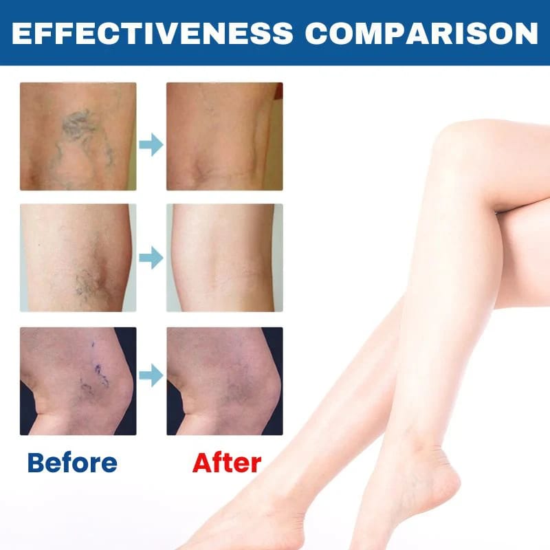 BioEquis Varicose Vein Spray