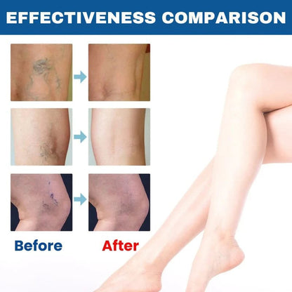 BioEquis Varicose Vein Spray